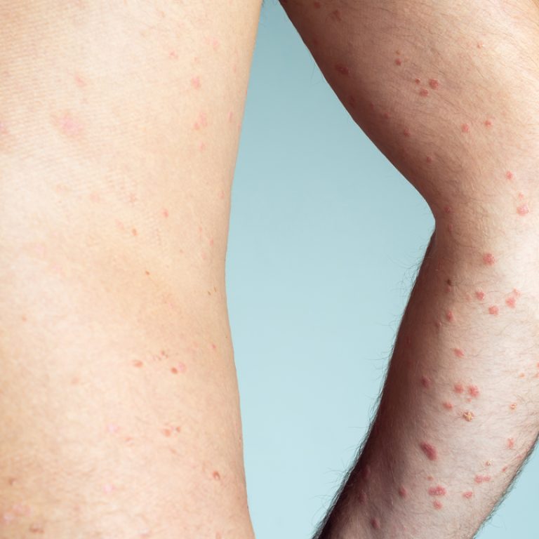 Εξειδικευμένη φροντίδα για χρόνιες δερματικές παθήσεις στη Θεσσαλονίκη