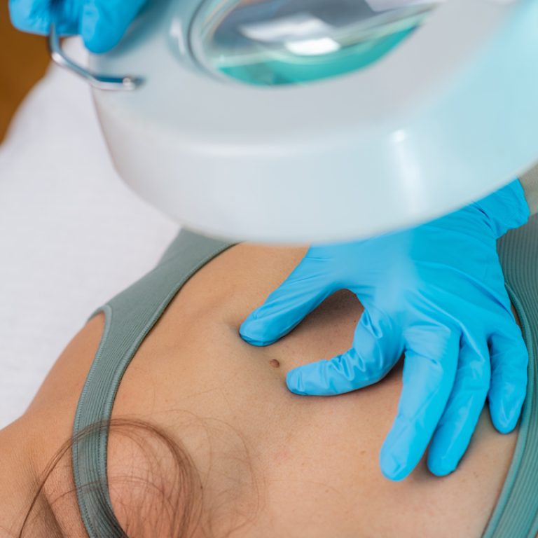 Δερματοσκόπηση και χαρτογράφηση σπίλων για πρόληψη καρκίνου δέρματος