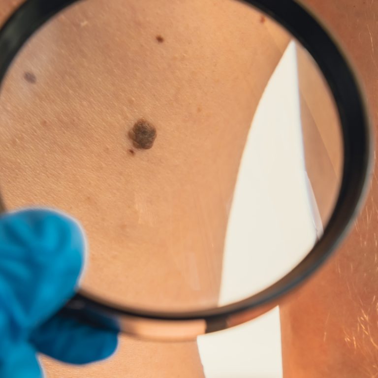 Καλοήθεις βλάβες δέρματος και δερματοσκόπηση για διάγνωση