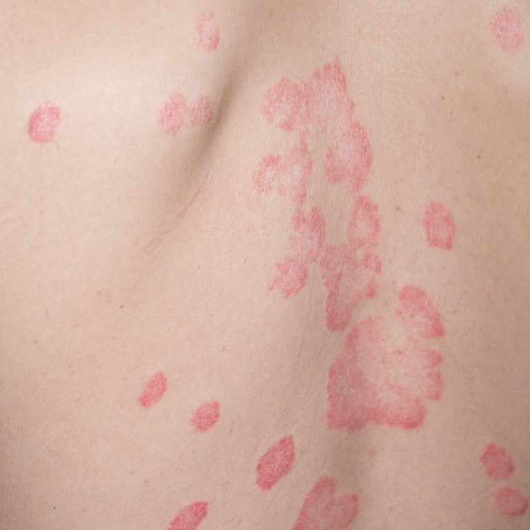 Φωτοθεραπεία και σύγχρονες θεραπείες για ψωρίαση στη Θεσσαλονίκη